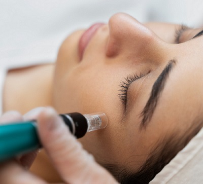 How Effective Is Micro Needling For Under Eye Dark Circles Treatment