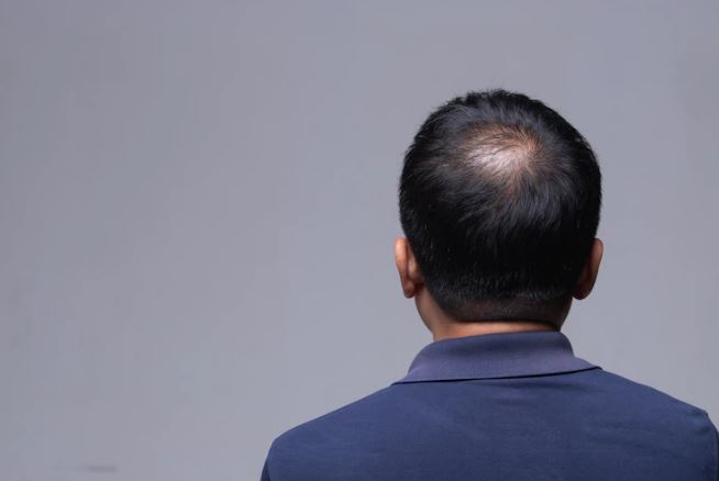 Everything That You Need To Know About Male Pattern Baldness
